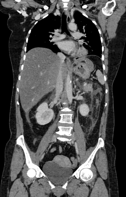 Acute pancreatitis (Radiopaedia 80007-93285 Coronal C+ portal venous phase 69).jpg