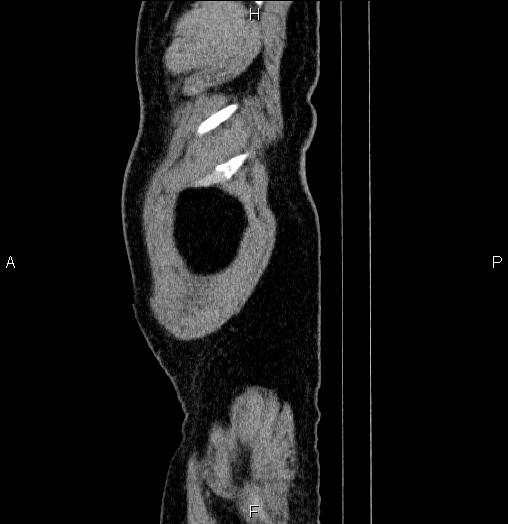 Acute pancreatitis (Radiopaedia 85390-101010 Sagittal C+ portal venous phase 104).jpg