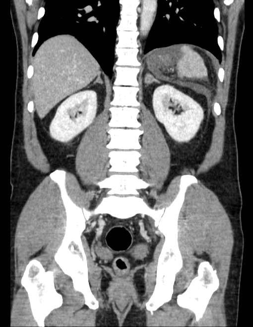 Acute pancreatitis - Balthazar E (Radiopaedia 23080-23110 Coronal C+ portal venous phase 56).jpg