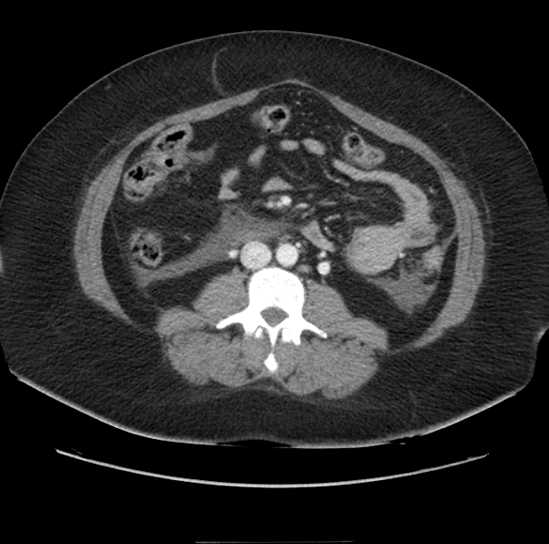 Acute pancreatitis - Balthazar E (Radiopaedia 29016-29377 Axial C+ portal venous phase 38).png