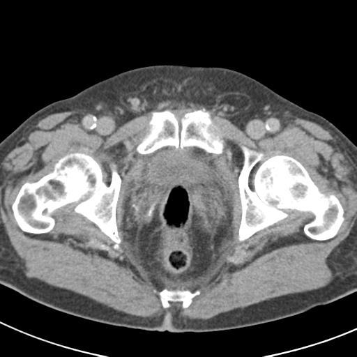 File:Acute pancreatitis and walled-off necrosis (Radiopaedia 29888-30403 Axial C+ delayed 81).jpg
