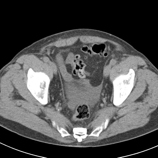 File:Acute pancreatitis and walled-off necrosis (Radiopaedia 29888-30403 Axial non-contrast 67).jpg