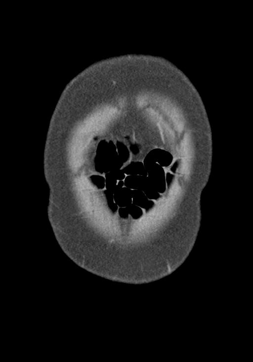 Acute pancreatitis and walled-off necrosis (Radiopaedia 29888-30403 E 7).jpg