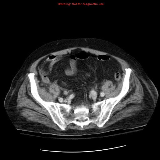 File:Acute pancreatitis with incidental pancreatic lipoma (Radiopaedia 10190-10730 Axial C+ portal venous phase 61).jpg