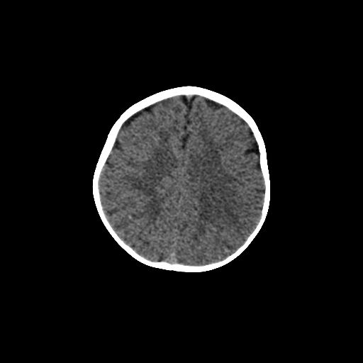 Acute phase of hemiconvulsion-hemiplegia epilepsy syndrome (Radiopaedia 29309-29744 Axial non-contrast 16).jpg