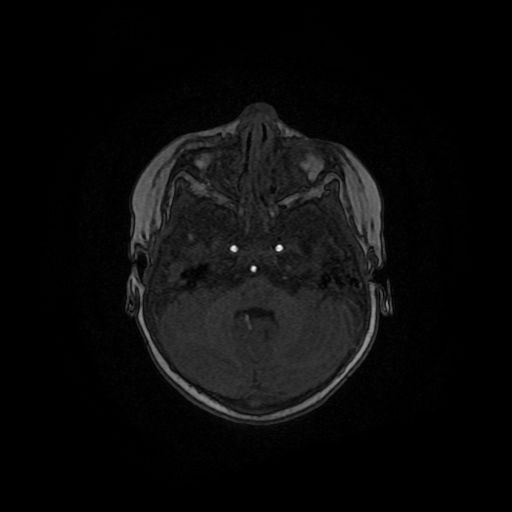 File:Acute phase of hemiconvulsion-hemiplegia epilepsy syndrome (Radiopaedia 29309-29745 Axial TOF angiography 116).jpg