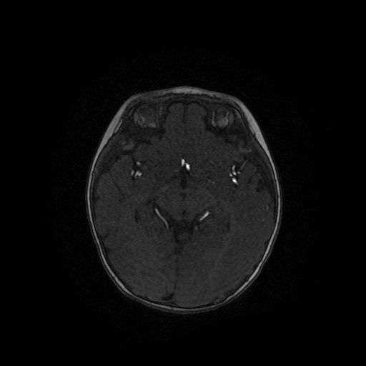 Acute phase of hemiconvulsion-hemiplegia epilepsy syndrome (Radiopaedia 29309-29745 Axial TOF angiography 69).jpg