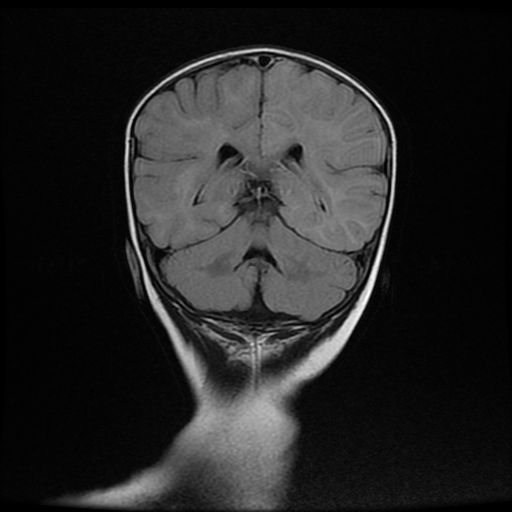 File:Acute phase of hemiconvulsion-hemiplegia epilepsy syndrome (Radiopaedia 29309-29745 Coronal FLAIR 15).jpg