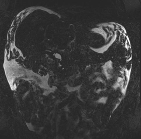Acute portal vein thrombosis (Radiopaedia 73198-83925 Coronal Heavily T2 thin cuts 34).jpg