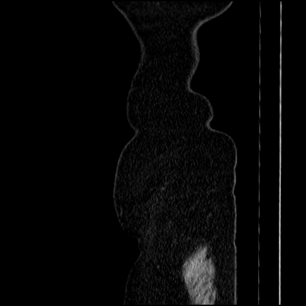 Acute pyelonephritis (Radiopaedia 33397-34434 Sagittal renal parenchymal phase 90).jpg