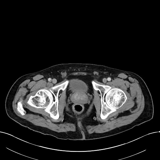 Acute renal infarction (Radiopaedia 59375-66736 Axial C+ portal venous phase 116).jpg