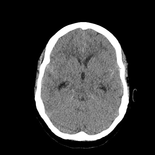 Acute subarachnoid hemorrhage and accessory anterior cerebral artery (Radiopaedia 69231-79008 Axial non-contrast 21).jpg