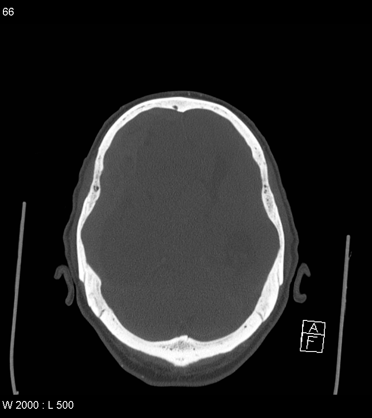 Acute subdural hematoma with myelofibrosis (Radiopaedia 52582-58494 Axial bone window 33).jpg