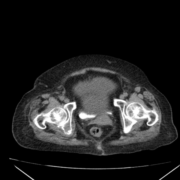 Acute tubular necrosis (Radiopaedia 28077-28334 Axial non-contrast 65).jpg