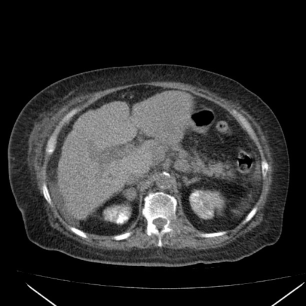 Acute tubular necrosis (Radiopaedia 28077-28334 F 23).jpg