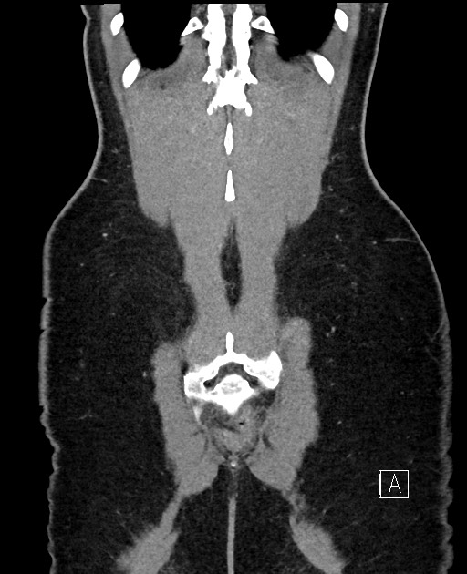 Acute uncomplicated appendicitis (Radiopaedia 61374-69304 Coronal C+ portal venous phase 95).jpg