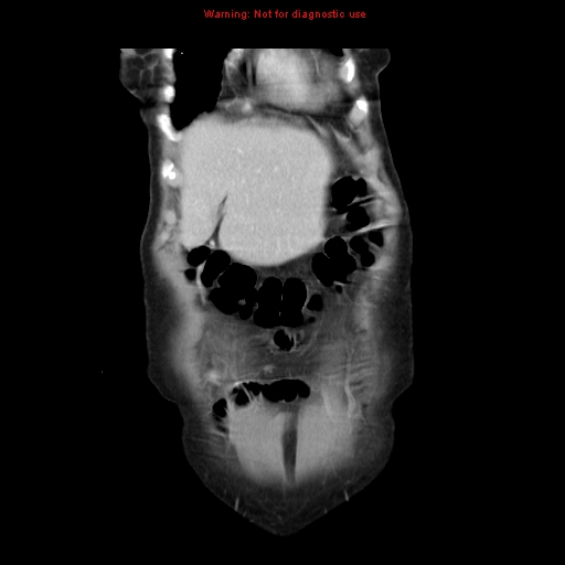 File:Adenocarcinoma of the colon (Radiopaedia 8191-9039 Coronal liver window 8).jpg