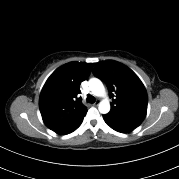 File:Adenocystic carcinoma of the trachea (Radiopaedia 47677-52525 Axial C+ arterial phase 44).jpg