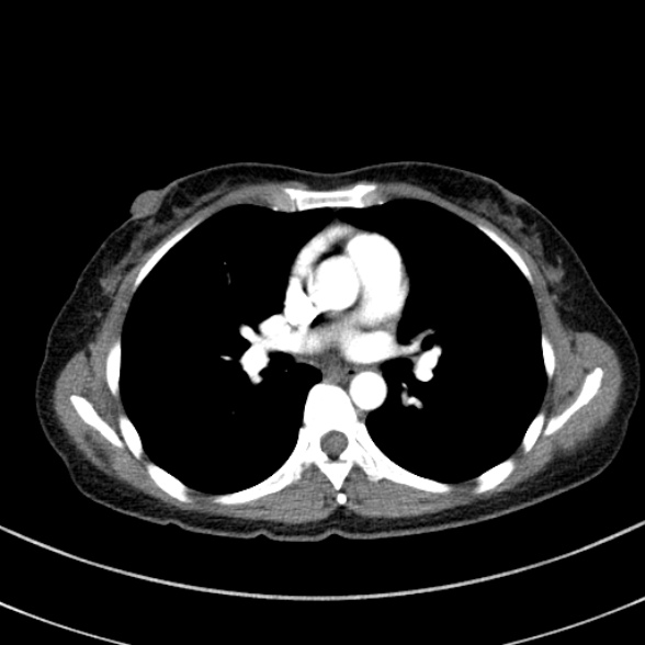File:Adenocystic carcinoma of the trachea (Radiopaedia 47677-52525 Axial C+ arterial phase 52).jpg