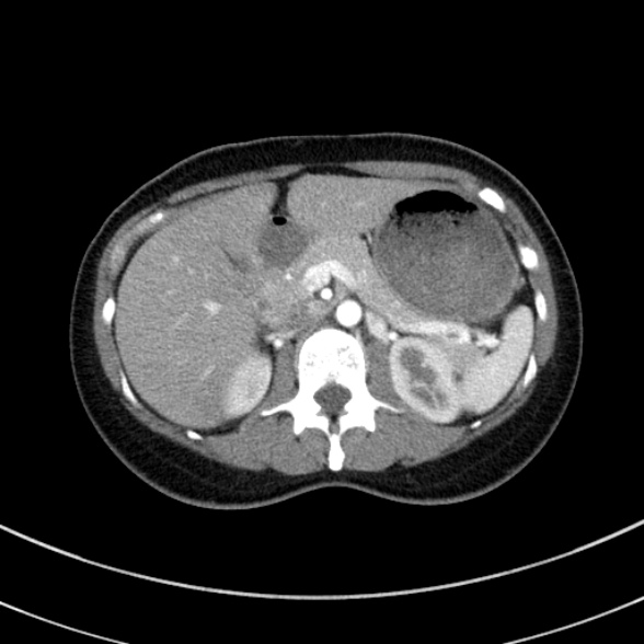 File:Adenocystic carcinoma of the trachea (Radiopaedia 47677-52525 Axial C+ arterial phase 83).jpg