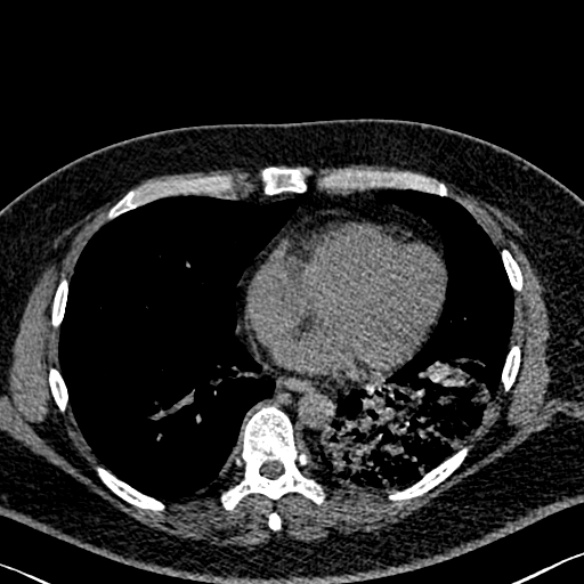 Adenoid cystic carcinoma of the trachea (Radiopaedia 49042-54137 Axial non-contrast 227).jpg