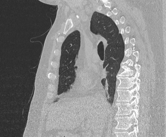 Adenoid cystic carcinoma of the trachea (Radiopaedia 49042-54137 Sagittal lung window 208).jpg