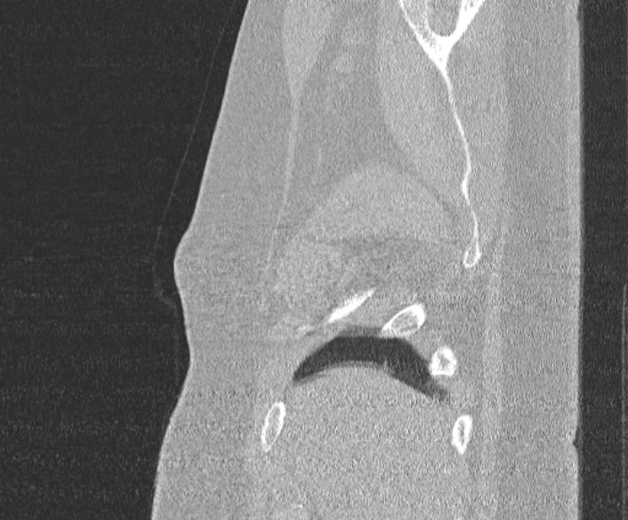 Adenoid cystic carcinoma of the trachea (Radiopaedia 49042-54137 Sagittal lung window 36).jpg