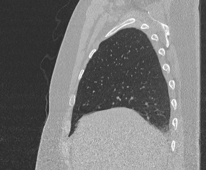File:Adenoid cystic carcinoma of the trachea (Radiopaedia 49042-54137 Sagittal lung window 99).jpg