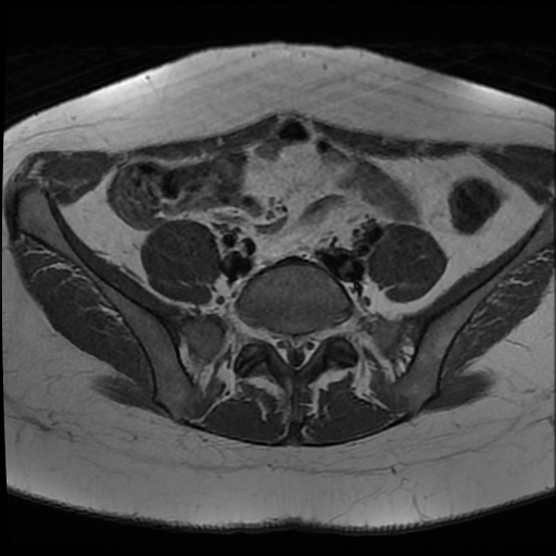 File:Adenomyosis-scar endometriosis (Radiopaedia 65863-75022 Axial T1 3).jpg