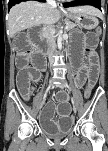 Adhesional small bowel obstruction (Radiopaedia 48397-53305 Coronal C+ portal venous phase 177).jpg