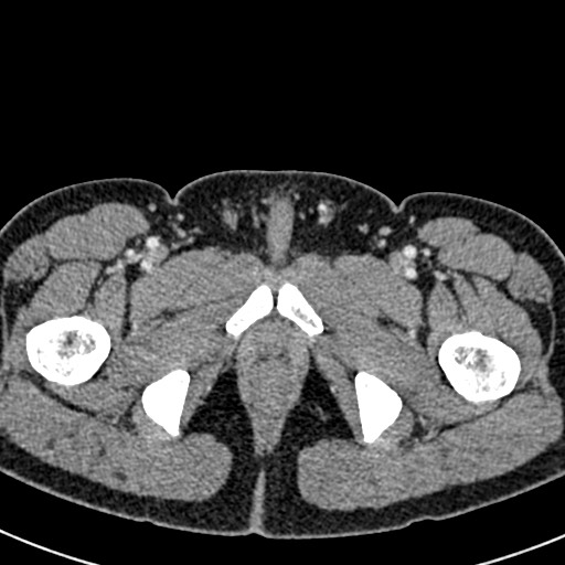 Adhesional small bowel obstruction (Radiopaedia 58900-66131 Axial C+ portal venous phase 56).jpg