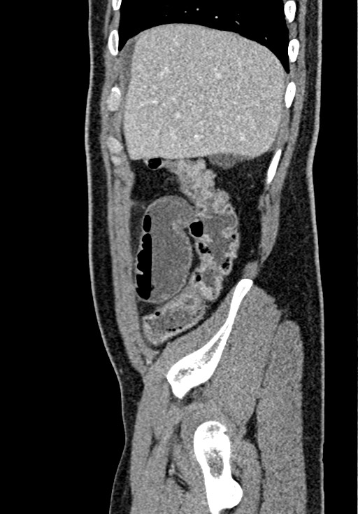 Adhesional small bowel obstruction (Radiopaedia 58900-66131 Sagittal C+ portal venous phase 45).jpg