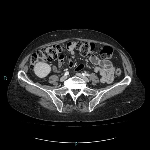 File:Adrenal collision tumor (ACT) (Radiopaedia 48462-53379 Axial C+ portal venous phase 41).jpg