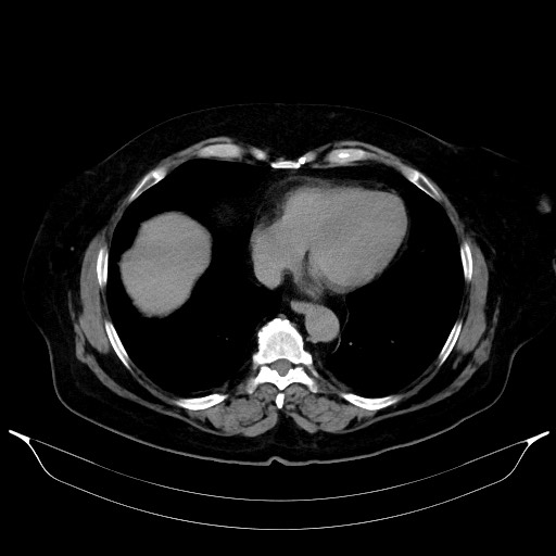 Adrenal cortical carcinoma (Radiopaedia 64017-72769 Axial C+ delayed 6).jpg