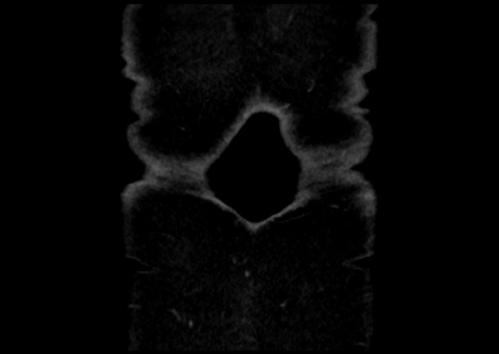 File:Adrenal cortical carcinoma (Radiopaedia 64017-72769 Coronal C+ portal venous phase 58).jpg