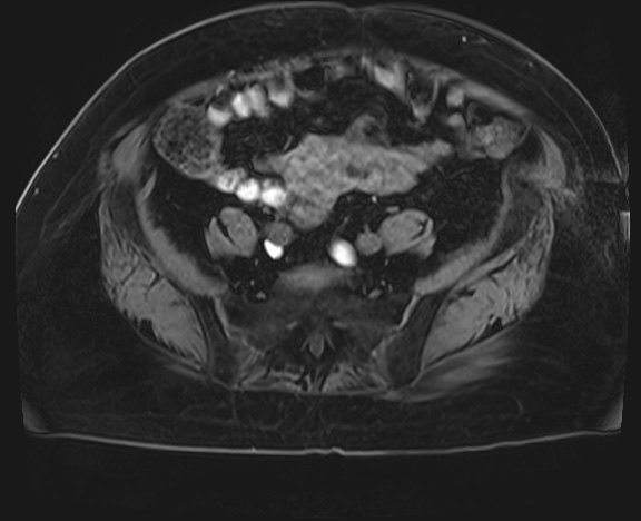 Adrenal cortical carcinoma (Radiopaedia 64017-72770 Axial T1 C+ fat sat 70).jpg