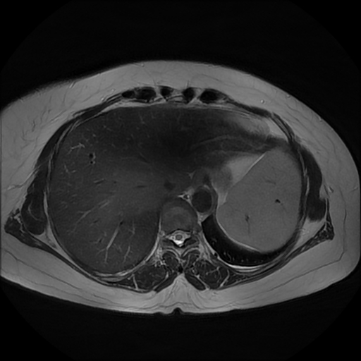File:Adrenal cortical carcinoma (Radiopaedia 70906-81116 Axial T2 4).jpg