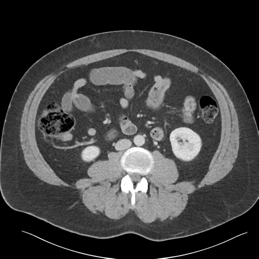Adrenal cyst (Radiopaedia 45625-49777 Axial C+ portal venous phase 56).png