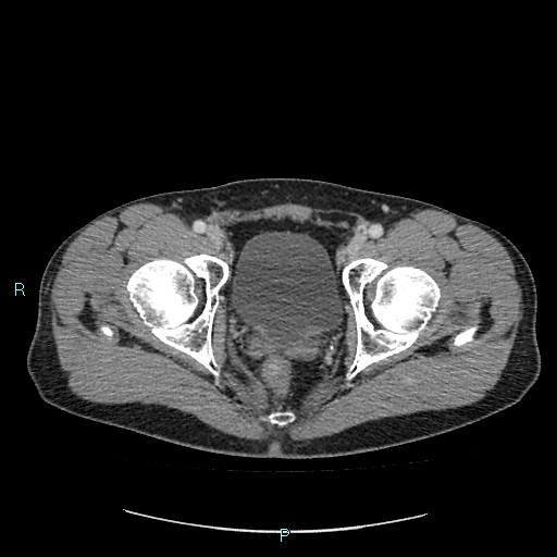 Adrenal cystic lymphangioma (Radiopaedia 83161-97534 Axial C+ portal venous phase 94).jpg