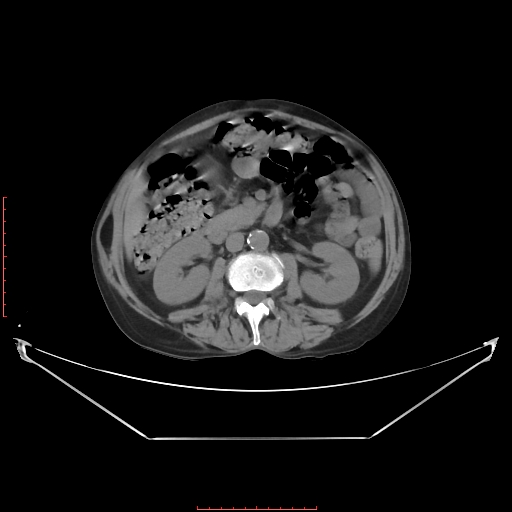 File:Adrenal hemangioma (Radiopaedia 68923-78668 Axial non-contrast 36).jpg