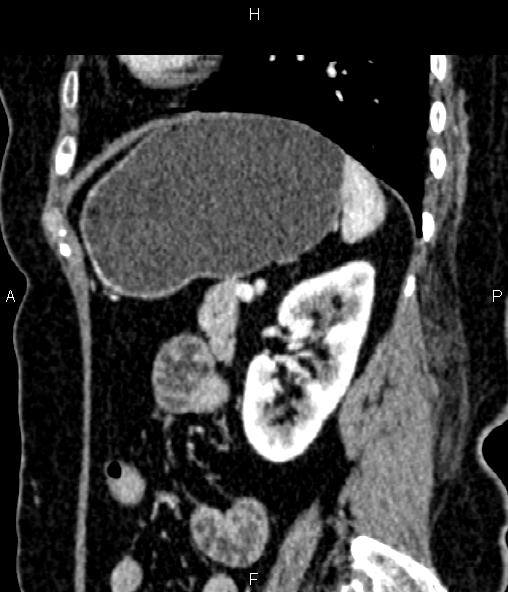 File:Adrenal myelolipoma (Radiopaedia 82742-96986 Sagittal renal cortical phase 76).jpg