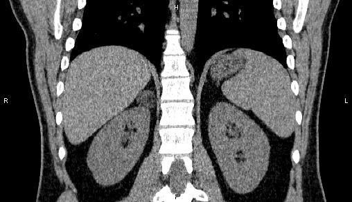 Adrenal myelolipoma (Radiopaedia 84321-99619 Coronal non-contrast 56).jpg
