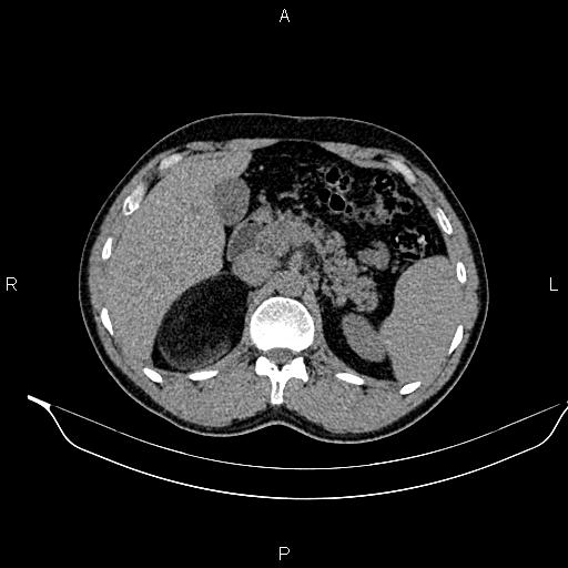 Adrenal myelolipoma (Radiopaedia 87794-104246 Axial non-contrast 35).jpg
