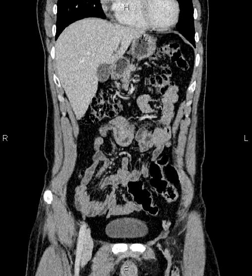 Adrenal myelolipoma (Radiopaedia 87794-104246 Coronal renal cortical phase 17).jpg