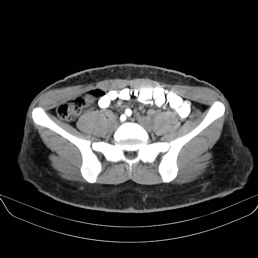 File:Adrenal myelolipoma - bilateral (Radiopaedia 74805-85810 Axial non-contrast 57).jpg