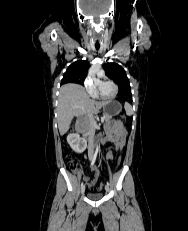 Adrenocortical carcinoma (Radiopaedia 80134-93438 Coronal C+ portal venous phase 75).jpg