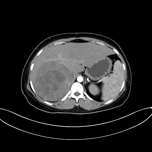 Adrenocortical carcinoma (Radiopaedia 87281-103569 Axial C+ arterial phase 24).jpg