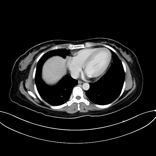 Adrenocortical carcinoma (Radiopaedia 87281-103569 Axial C+ portal venous phase 9).jpg