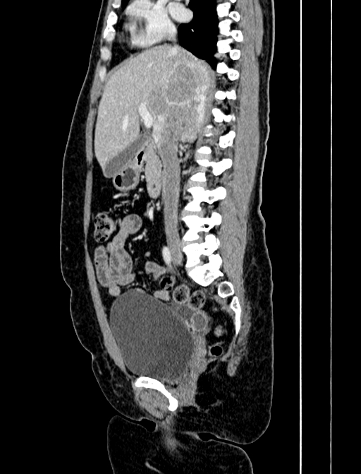 Adrenocortical carcinoma (Radiopaedia 87281-103569 Sagittal C+ portal venous phase 124).jpg