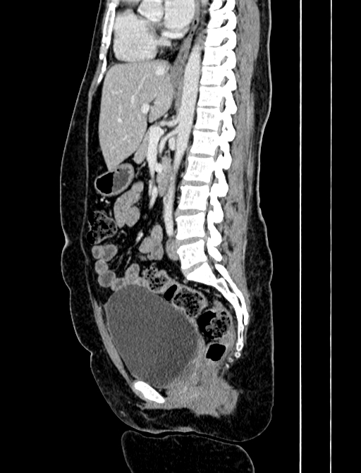 Adrenocortical carcinoma (Radiopaedia 87281-103569 Sagittal C+ portal venous phase 160).jpg